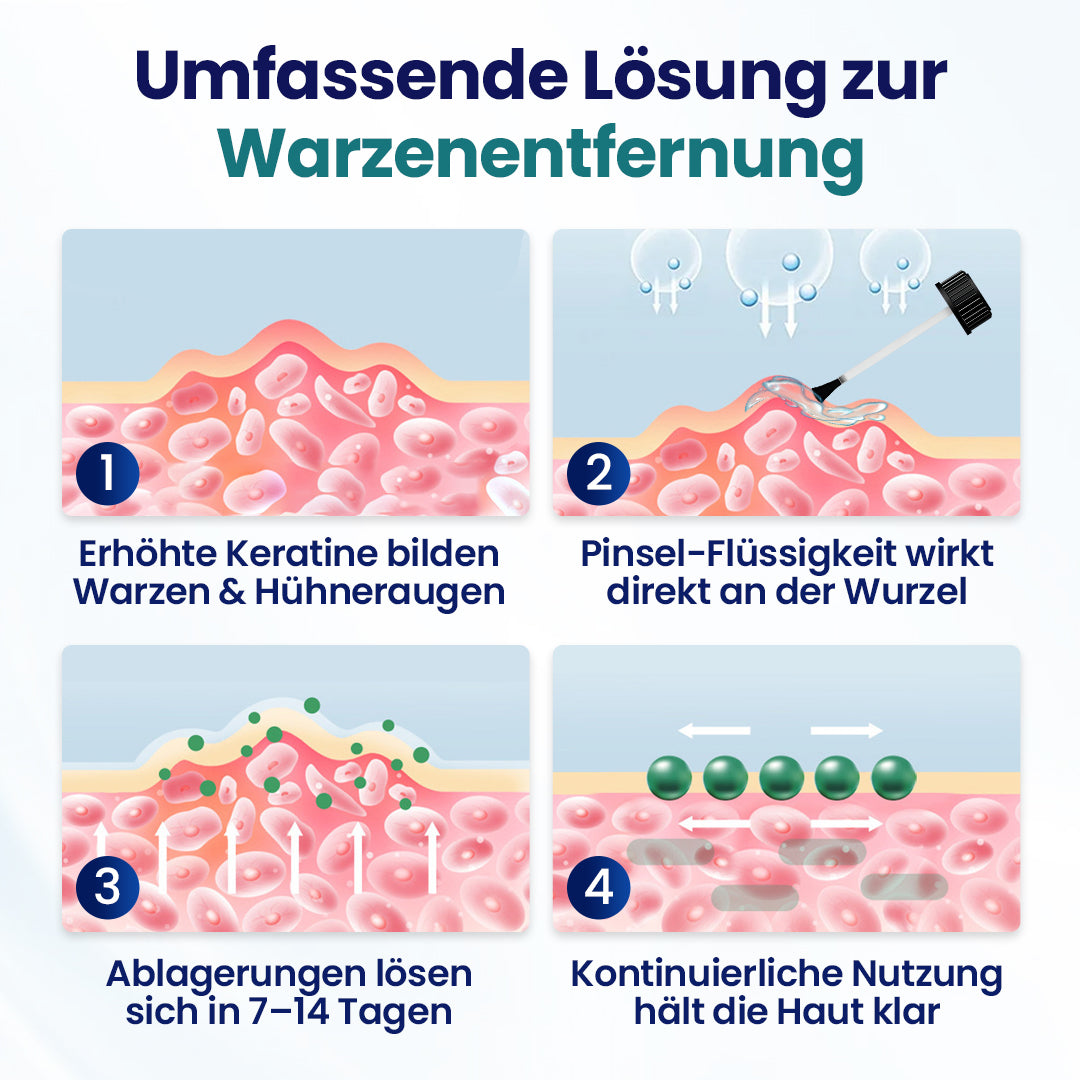 Timilk® WartLift Warzen-Entfernungsflüssigkeit ✨