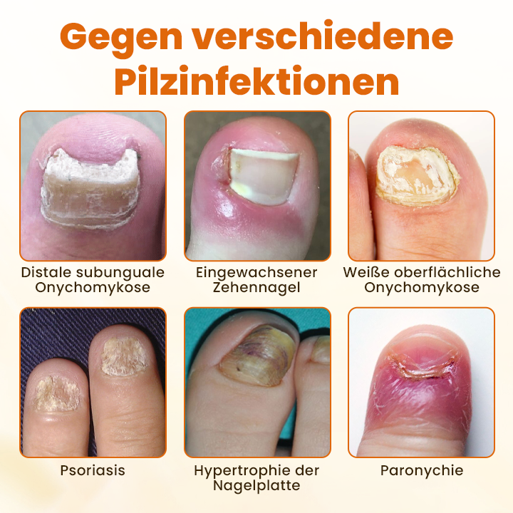 Timilk® FungiBee Fortschrittliches Nagelreparatur-Spray🔥