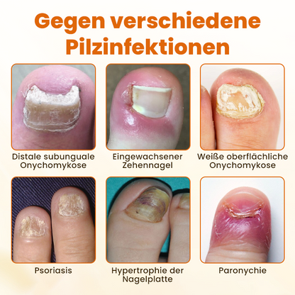 Timilk® FungiBee Fortschrittliches Nagelreparatur-Spray🔥