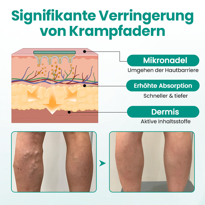 Timilk® LegRenew Krampfaderpflaster✨