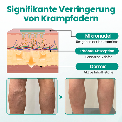 Timilk® LegRenew Krampfaderpflaster✨