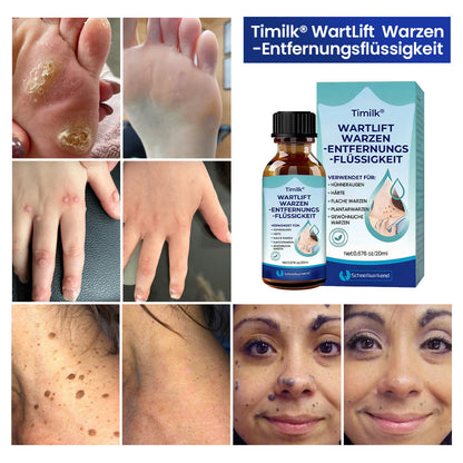 Timilk® WartLift Warzen-Entfernungsflüssigkeit ✨