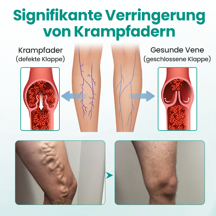 Timilk® LegRenew Krampfaderpflaster✨